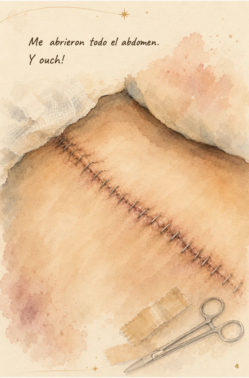 Cicatriz de grapas quirúrgicas en el abdomen de Camila. Me abrieron todo el abdomen. Y oush!